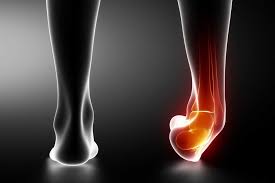 Ankle sprain